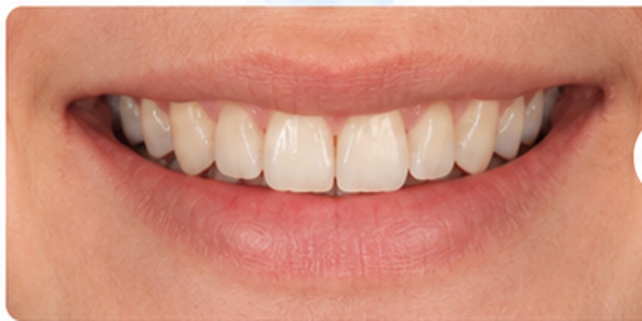 Before example of adult clear aligner treatment