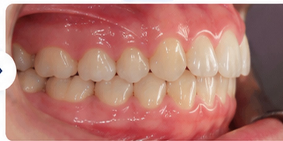 After example of bite improvement orthodontic treatment
