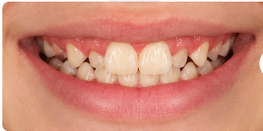 Before example of teen braces treatment with crowded teeth